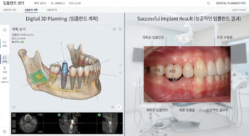 3D 스캔과 시술 결과 비교 이미지
