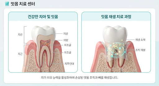 잇몸 재생 치료 3D 일러스트