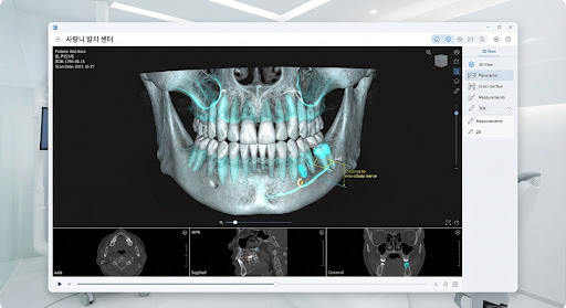 사랑니 3D CT 진단 영상